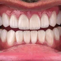 جشنواره کامپوزیت لمینت پرداخت اقساط