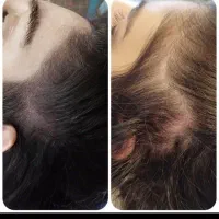 راه نجات کم‌پشتی مو با میکرواسکالپ|خدمات آرایشگری و زیبایی|دزفول, |دیوار
