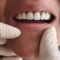 دندان مصنوعی در محل شما با کیفیت تضمینی|خدمات آرایشگری و زیبایی|هشتگرد, شهرک ریحانه|دیوار