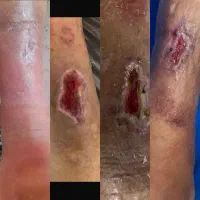 کلینیک تخصصی درمان انواع زخم(بستر و دیابت) فردوس|خدمات آرایشگری و زیبایی|اصفهان, محله سفلی|دیوار