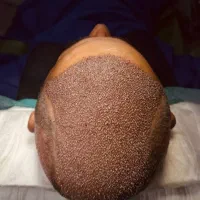 کاشت مو با تراکم بالا و تخفیف ویژه