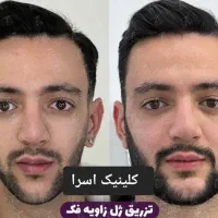 فول فیس ژل لب فیلربیکینی تخفیفات فقط دو روز|خدمات آرایشگری و زیبایی|مشهد, احمدآباد|دیوار