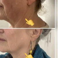 لاغری و جوانسازی با دستگاه هایفو(زیبایی و پزشکی)|خدمات آرایشگری و زیبایی|مسجد سلیمان, |دیوار