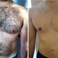 لیزر موهای زائد مخصوص آقایون ،در مطب شاین|خدمات آرایشگری و زیبایی|بم, |دیوار