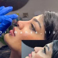 تزریق تخصصی فیلر زیر چشم بینی ژل لب روسی لیفت گونه|خدمات آرایشگری و زیبایی|تهران, پونک|دیوار