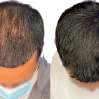 میکرواسکالپ،پرپشتی مو تضمینی|خدمات آرایشگری و زیبایی|مشهد, صیاد شیرازی|دیوار