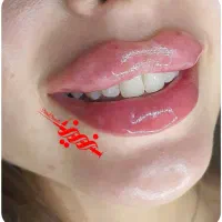 تزریق فیلر ژل و بوتاکس در کلینیک