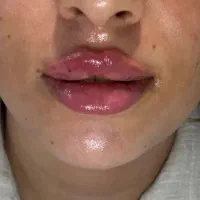 تزریق ژل به صورت حرفه ای