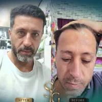 کاشت مو و ابرو