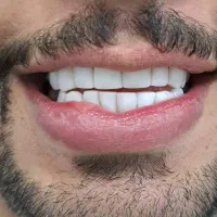 آموزش کامپوزیت دندان۱۰تومن