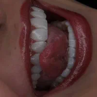 جشنواره کامپوزیت،لمینت دندان اقساطی بدون چک و ضامن