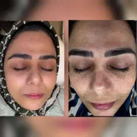 پک جوانساز صورت