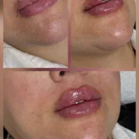 لیزرموهای زائد،ژل وبوتاکس،پی آرپی و کربوکسی .دالیا