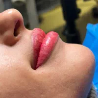 میکروبلیدینگ و شیدلب