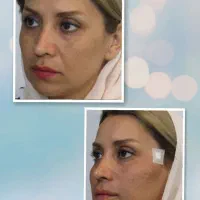 تنهامرکزانجام لیفت صورت،بابیشترین تعدادنخpdoدرمشهد