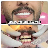 لمینت لیرینگ  ده تومن پیش پرداخت اصفهان|خدمات آرایشگری و زیبایی|شهرضا, |دیوار