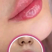 جشنواره تزریق ژل ۳۸۰ هزاروبوتاکس توسط کادردرمان