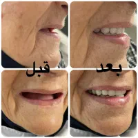 دندانسازی ، دندان مصنوعی