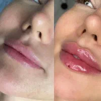 ژل روسی و بوتاکس لیفت فقط ۵۹۰