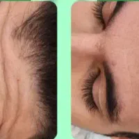 هایفو بوتاکس ژل لب زاویه سازی فیلر بادی هیپ سینه|خدمات آرایشگری و زیبایی|تهران, نارمک|دیوار