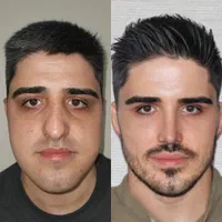 جراحی عمل بینی ۲۴ میلیونی/رینوپلاستی/بینی فانتزی|خدمات آرایشگری و زیبایی|تهران, مطهری|دیوار