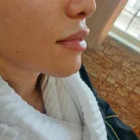لیزر بوتاکس ژل زیبایی
