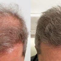 پی آر پی *بدون‌درد* prp قطع ریزش مو با ضمانت  365ت|خدمات آرایشگری و زیبایی|تبریز, |دیوار