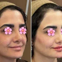 کلینیک تخصصی  خدمات زیبایی(ژل و بوتاکس ) با تخفیف|خدمات آرایشگری و زیبایی|کاشان, فین کوچک|دیوار