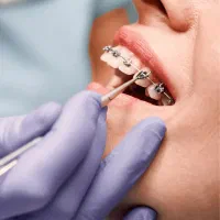 ارتودنسی اقساطی بدون چک معاینه رایگان|خدمات آرایشگری و زیبایی|اندیشه, شهرک صدف|دیوار