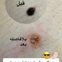 برداشتن خال و زگیل در یک جلسه