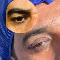 جشنواره یلدا قیمت های باورنکردنی ابدوساکشن بلفارو