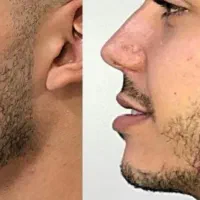 آنزم و مزو تراپی و فیلر و بوتاکس|خدمات آرایشگری و زیبایی|قرچک, مهدیه|دیوار