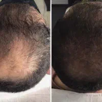 پسر بی ریش مو کنسل