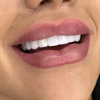 ترمیم عصب کشی روکش کامپوزیت زیبایی