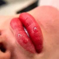 میکروبلیدینگ،شیدینگ لب ،بن مژه