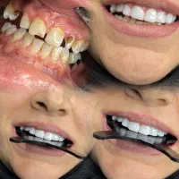 تخفیف ویژه کامپوزیت برای لبخندی بهتر