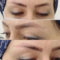 کاشت ابروی گیسو