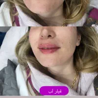 جشنواره پاییزه بوتاکس و فیلر و لیزر با تخفیف۳۰درصد|خدمات آرایشگری و زیبایی|اصفهان, فیض|دیوار