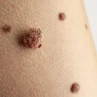 بهبود و کنترل زگیل تناسلی با مکملات کاملن گیاهی|آرایشی، بهداشتی، درمانی|گرگان, |دیوار