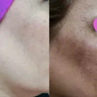 فقط در ۱۰روز تمام لک های صورتت و از بین ببر