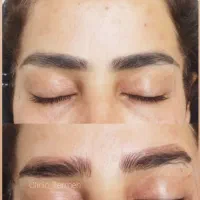 پاک کردن تتو با لیزر کیوسویچ