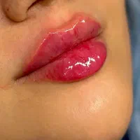 تزریق فیلر و بوتاکس و آنزیم با بهترین کیفیت|خدمات آرایشگری و زیبایی|قم, صدوق|دیوار