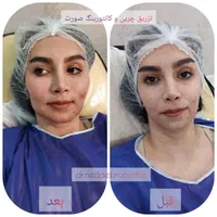 تزریق چربی ،فیلر بادی،عمل پلک،ژل و بوتاکس