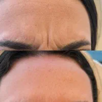 تزریق ژل چربی بوتاکس جوان ساز مزو پی آرپی