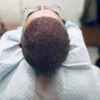 کاشت مو با جدید ترین روش بدون جراحی و درد