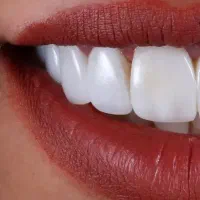 لمینت.کامپوزیت.عصبکشی|خدمات آرایشگری و زیبایی|تهران, کرمان|دیوار
