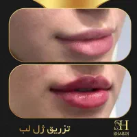 تزریقات زیبایی ژل،بوتاکس،هایفوتراپی،مزوتراپی وفیلر|خدمات آرایشگری و زیبایی|تهران, جنت‌آباد جنوبی|دیوار