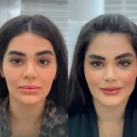 تزریق تخصصی ژل وبوتاکس،هایفو،پاک کردن تتوتوسط پزشک|خدمات آرایشگری و زیبایی|کرمانشاه, |دیوار