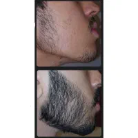 پرپشتی ریش بدون کاشت و خون ریزی|آرایشی، بهداشتی، درمانی|مرودشت, بیست متری بیمارستان|دیوار