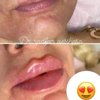 جشنواره بلفاروپلاستی ،اندولیف ،ساکشن غبغب|خدمات آرایشگری و زیبایی|تهران, بلوار کشاورز|دیوار